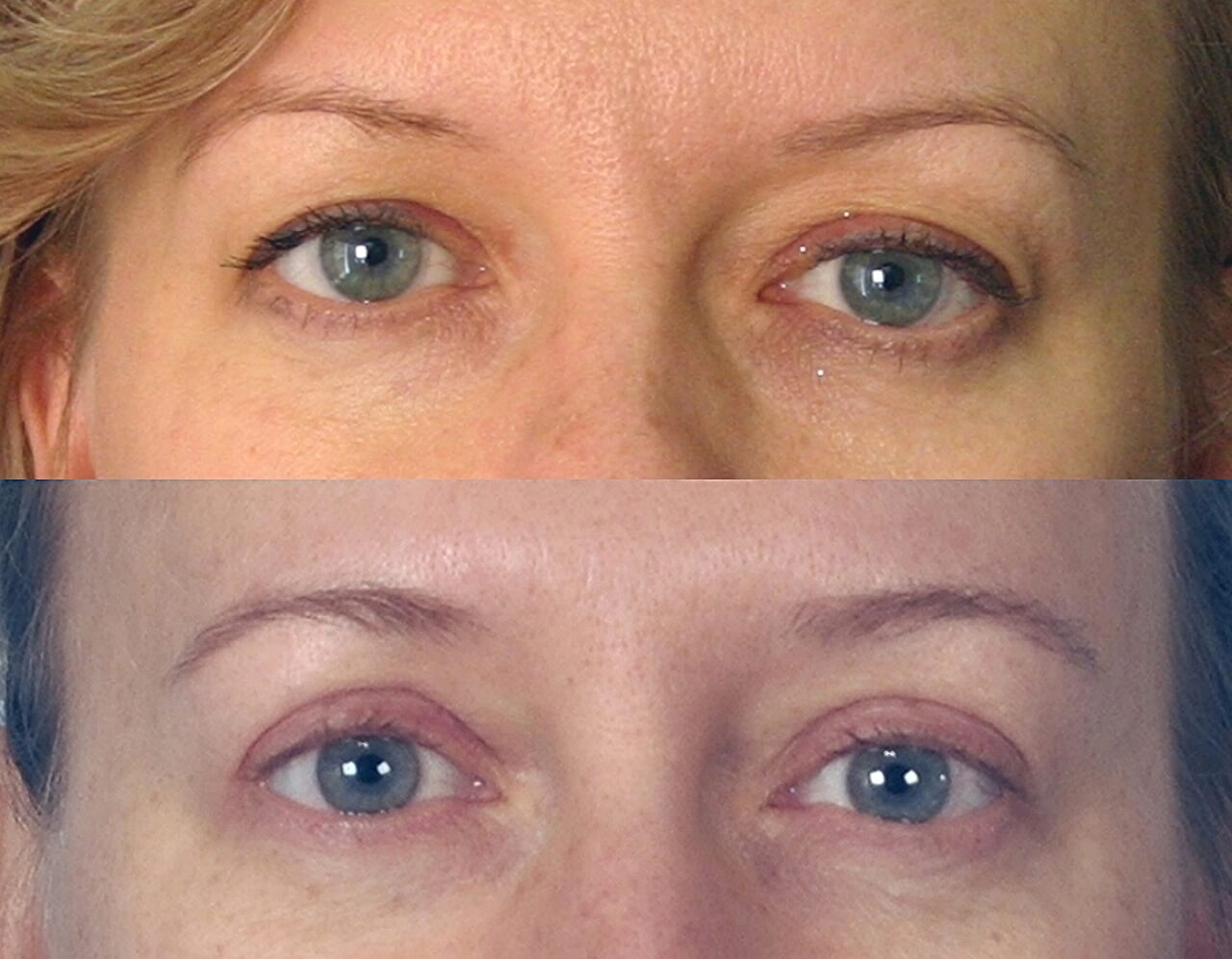 Case--0004 | Before and After Blepharoplasty
