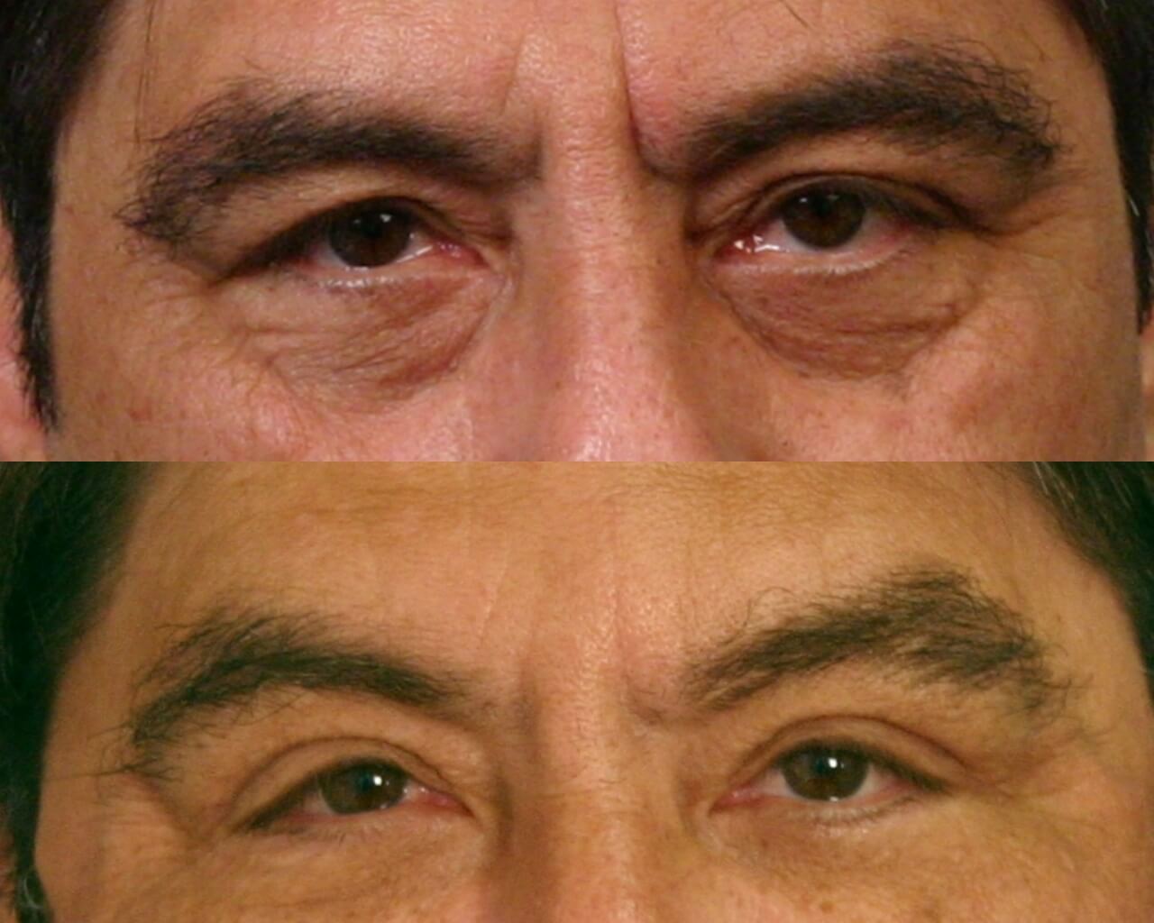 Case--0005 | Before and After Blepharoplasty