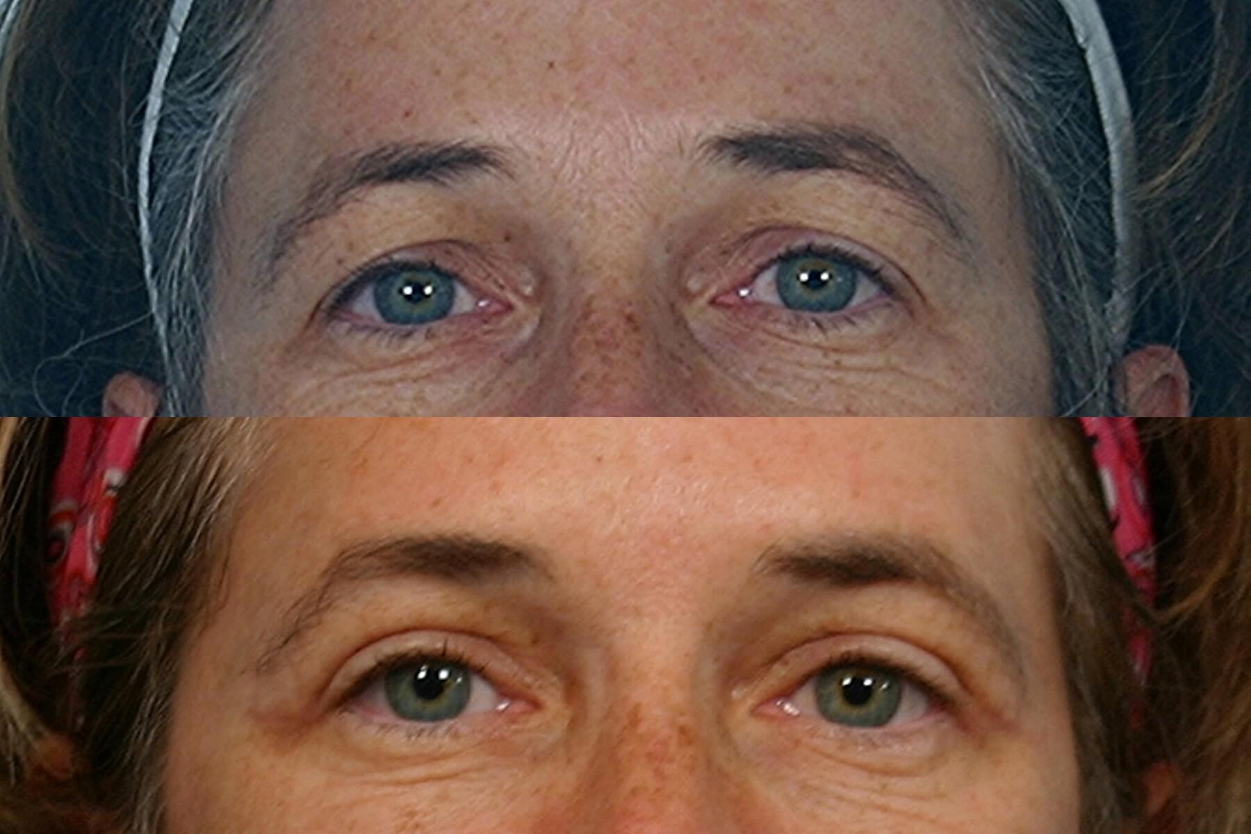 Case--0006 | Before and After Blepharoplasty
