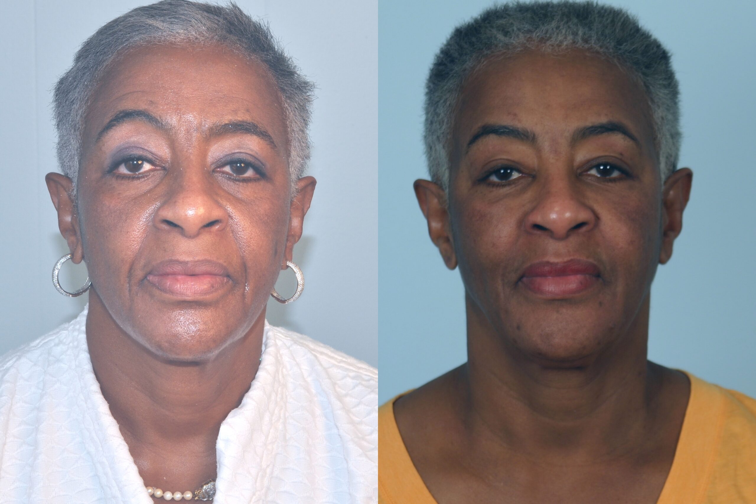 Case--4405 | Before and After Fat Transfer Face