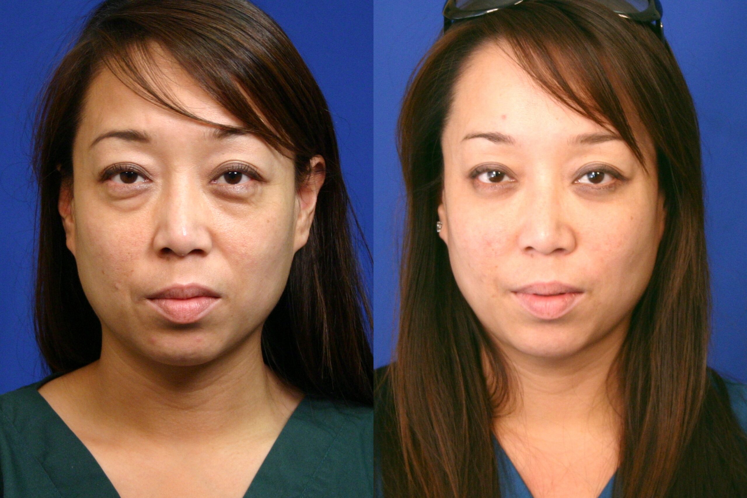 Case--4412 | Before and After Fat Transfer Face