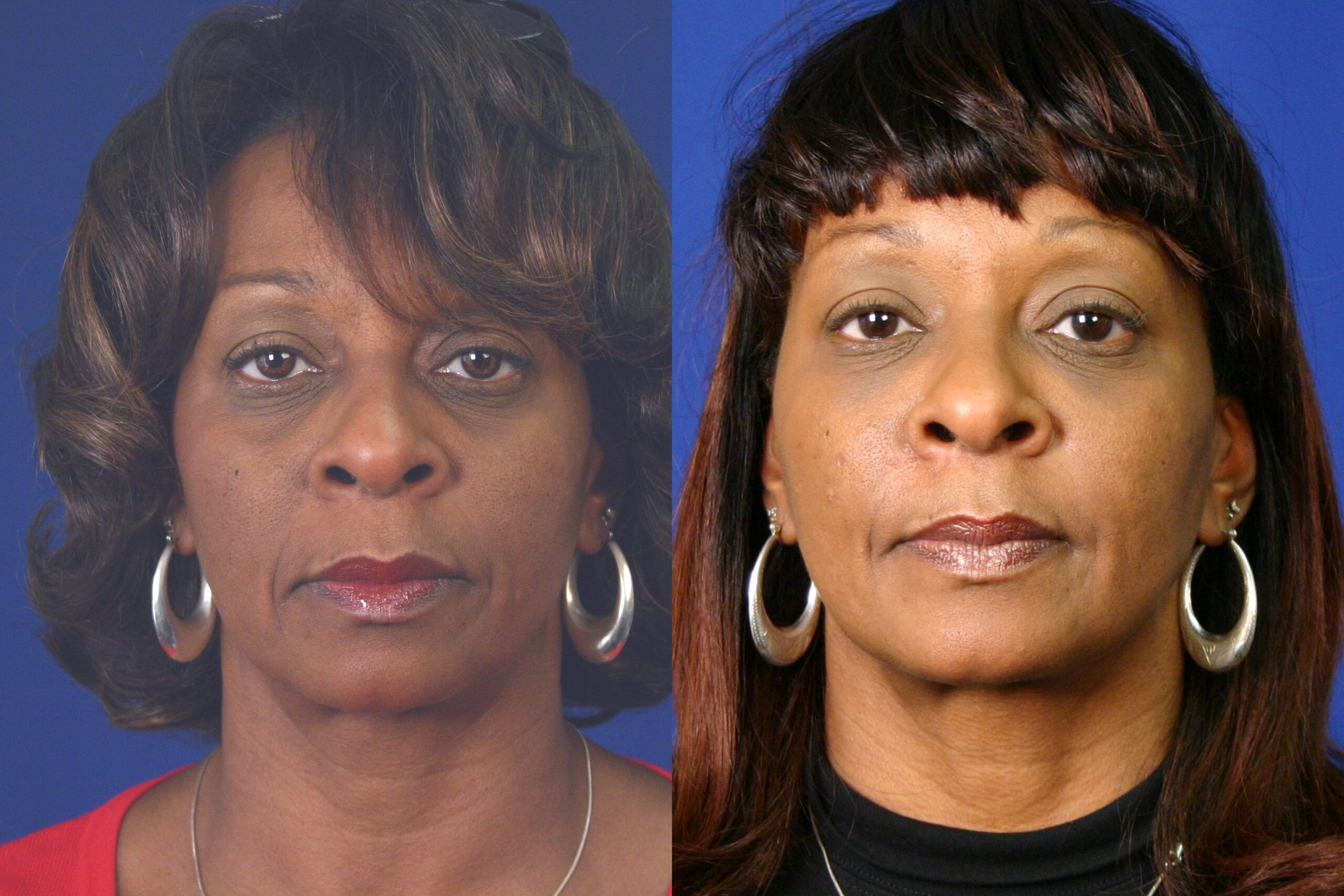 Case--4401 | Before and After Fat Transfer Face