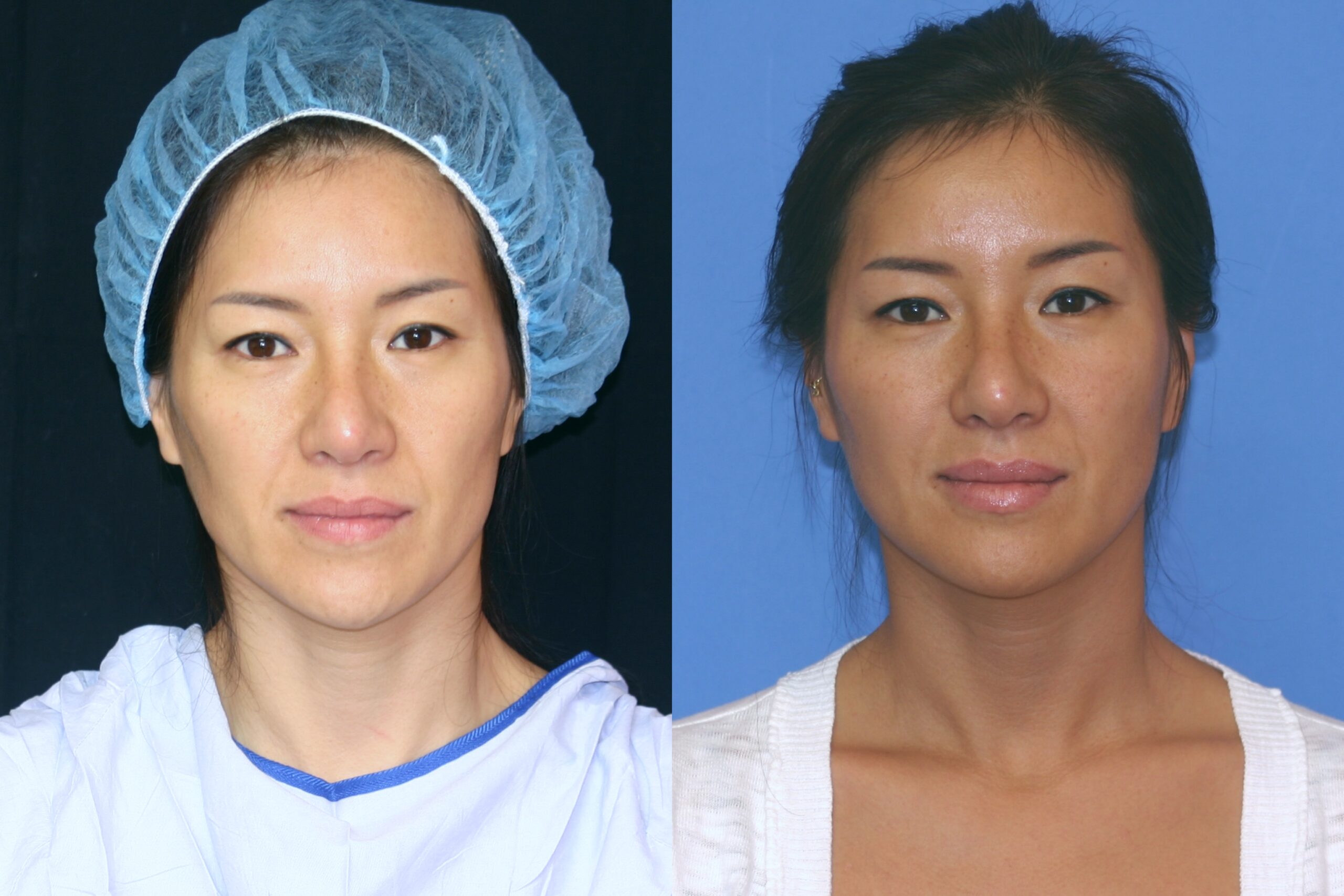 Case--4410 | Before and After Fat Transfer Face