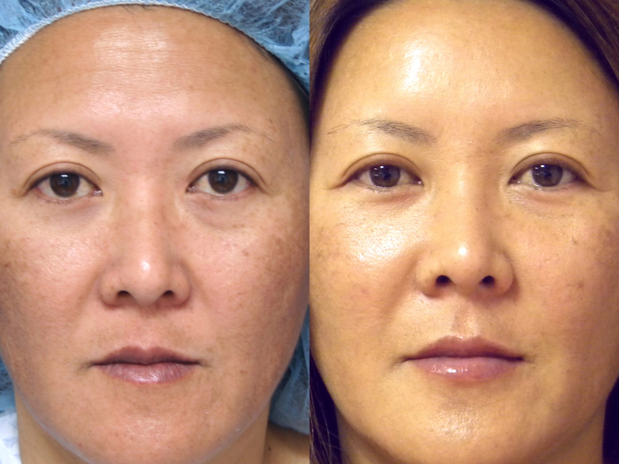 Case--4407 | Before and After Fat Transfer Face