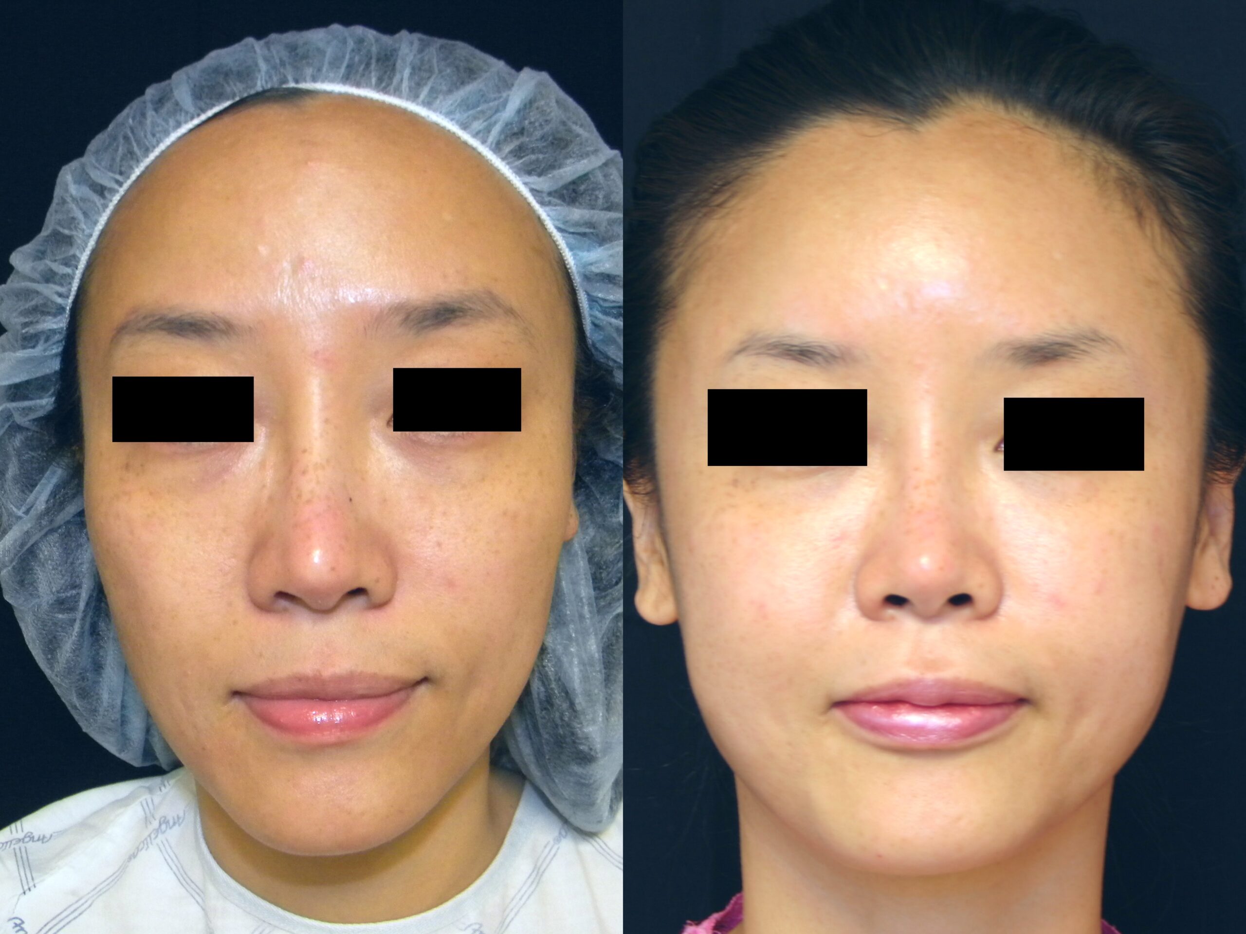 Case--4408 | Before and After Fat Transfer Face