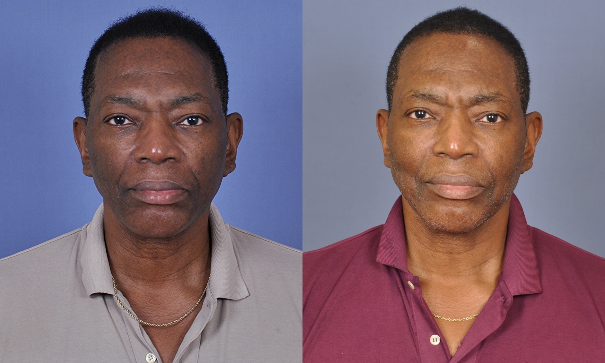 Case--4406 | Before and After Fat Transfer Face