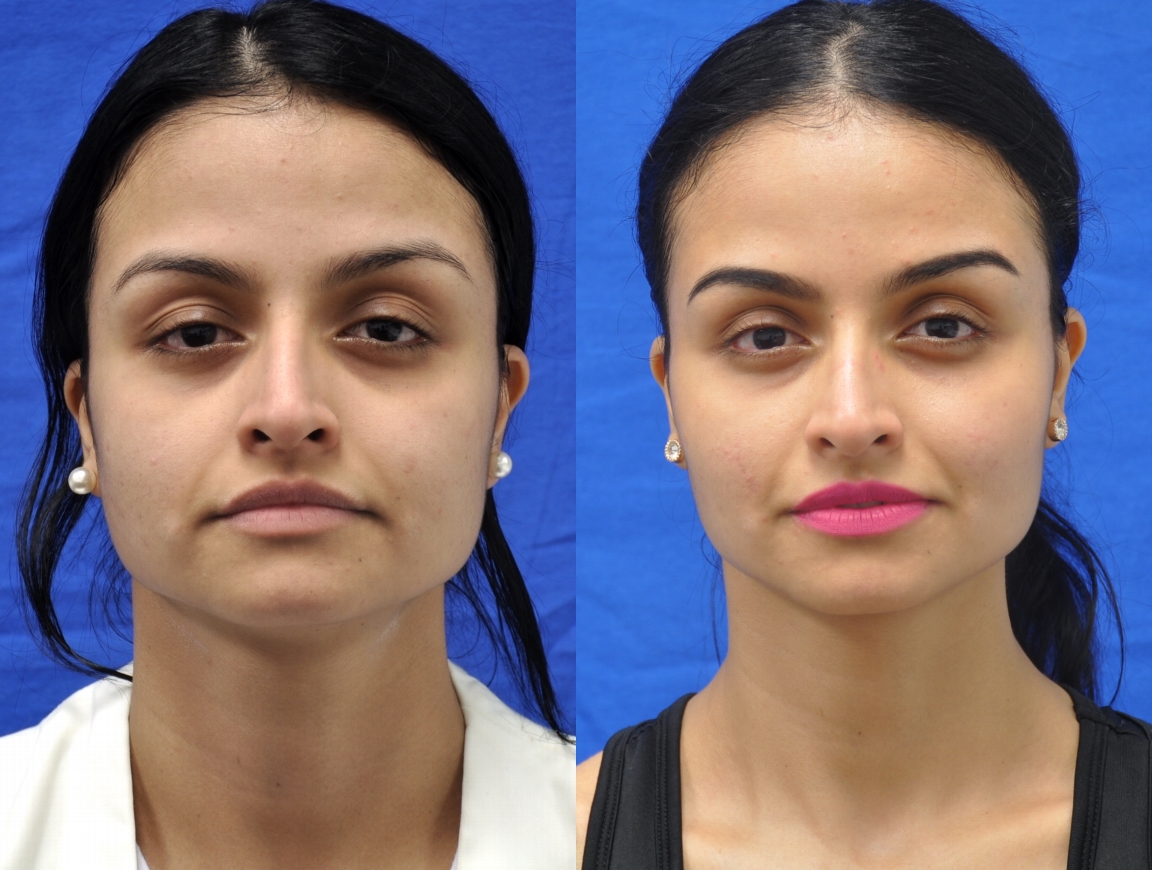Case--4402 | Before and After Fat Transfer Face