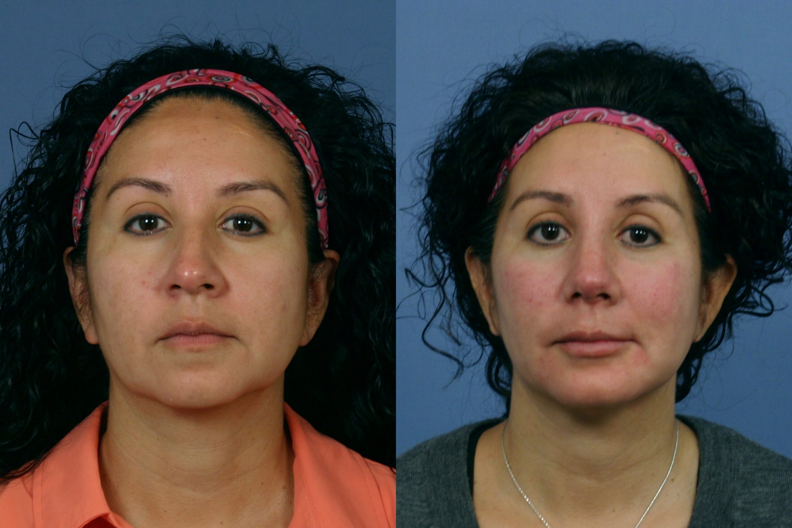 Case--4409 | Before and After Fat Transfer Face