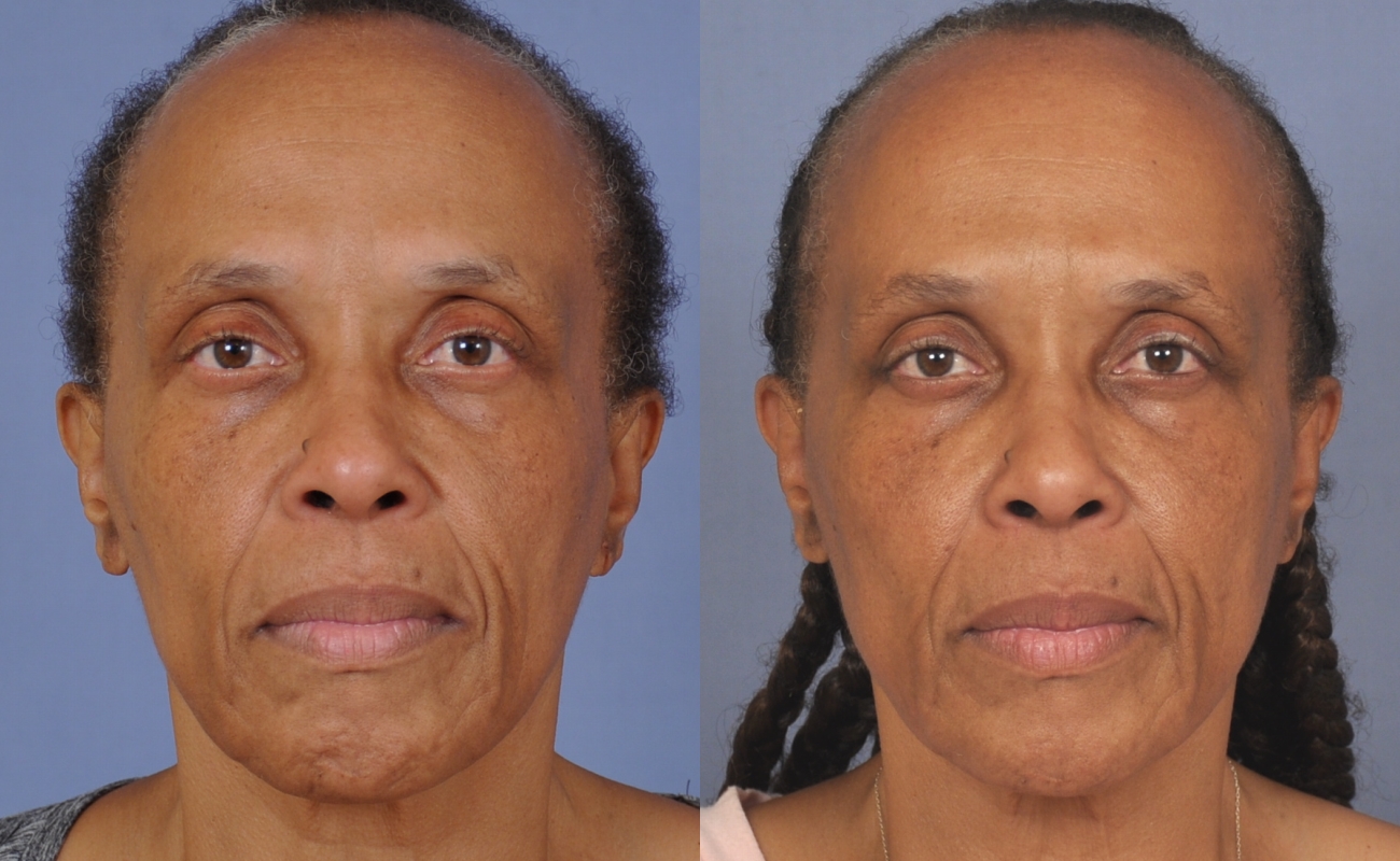 Case--4404 | Before and After Fat Transfer Face