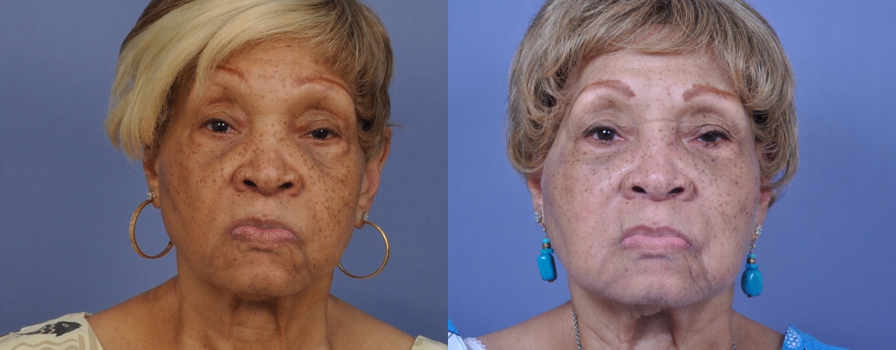 Case--4403 | Before and After Fat Transfer Face
