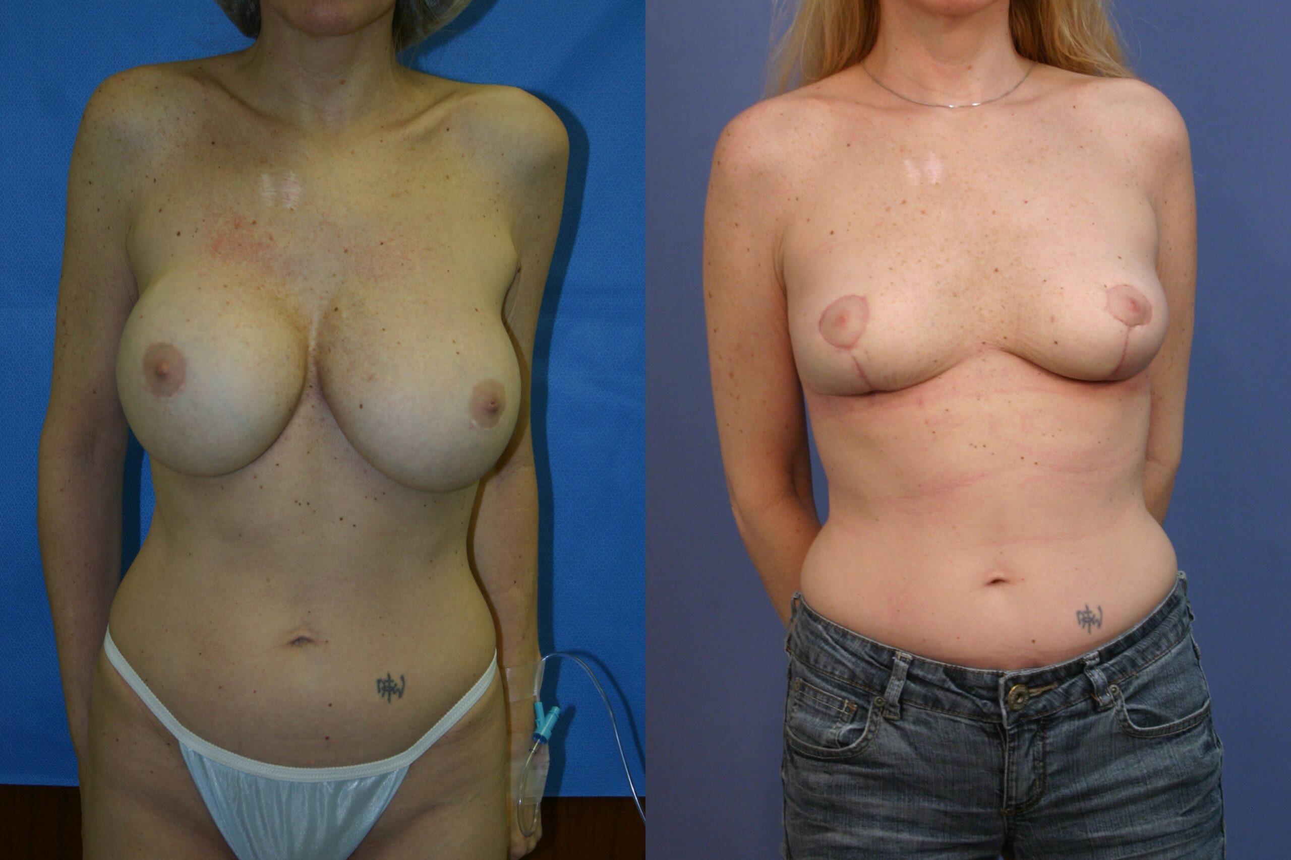 Breast-implant-removal-and-breast-lift-07 | Before and After Breast Lift