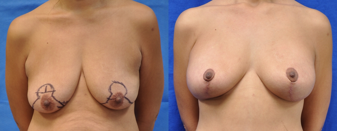 Breast-lift-patient-3 | Before and After Breast Lift