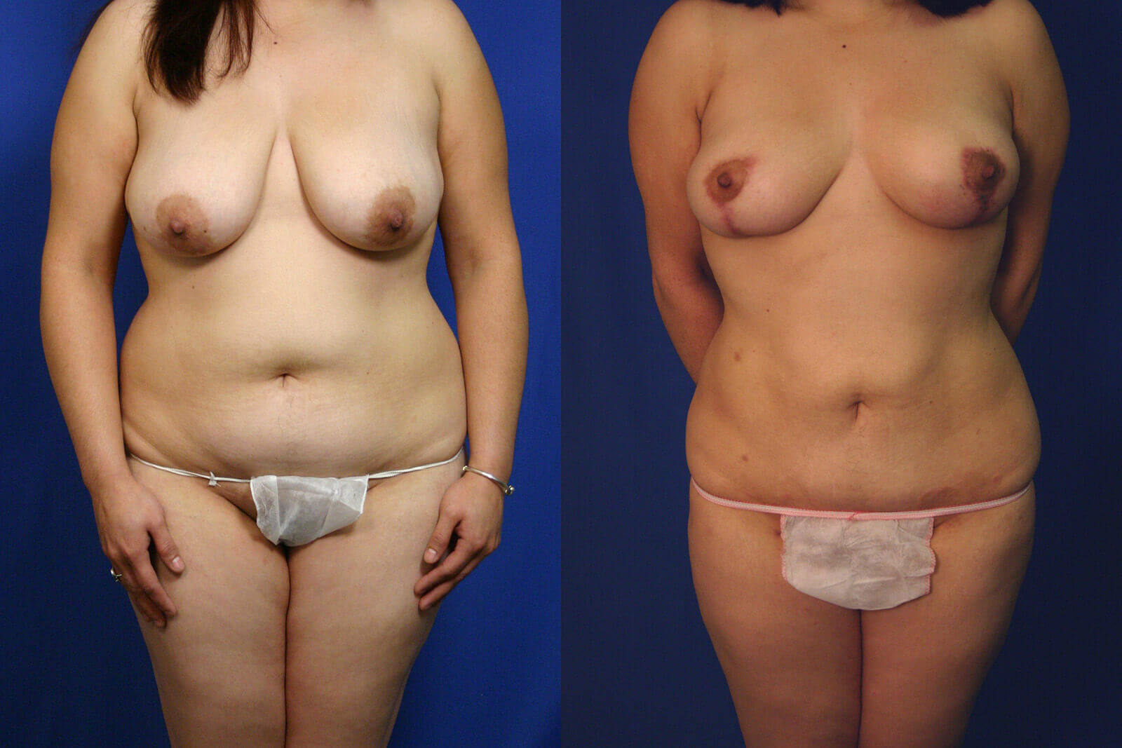 Case--8001 | Before and After Liposuction