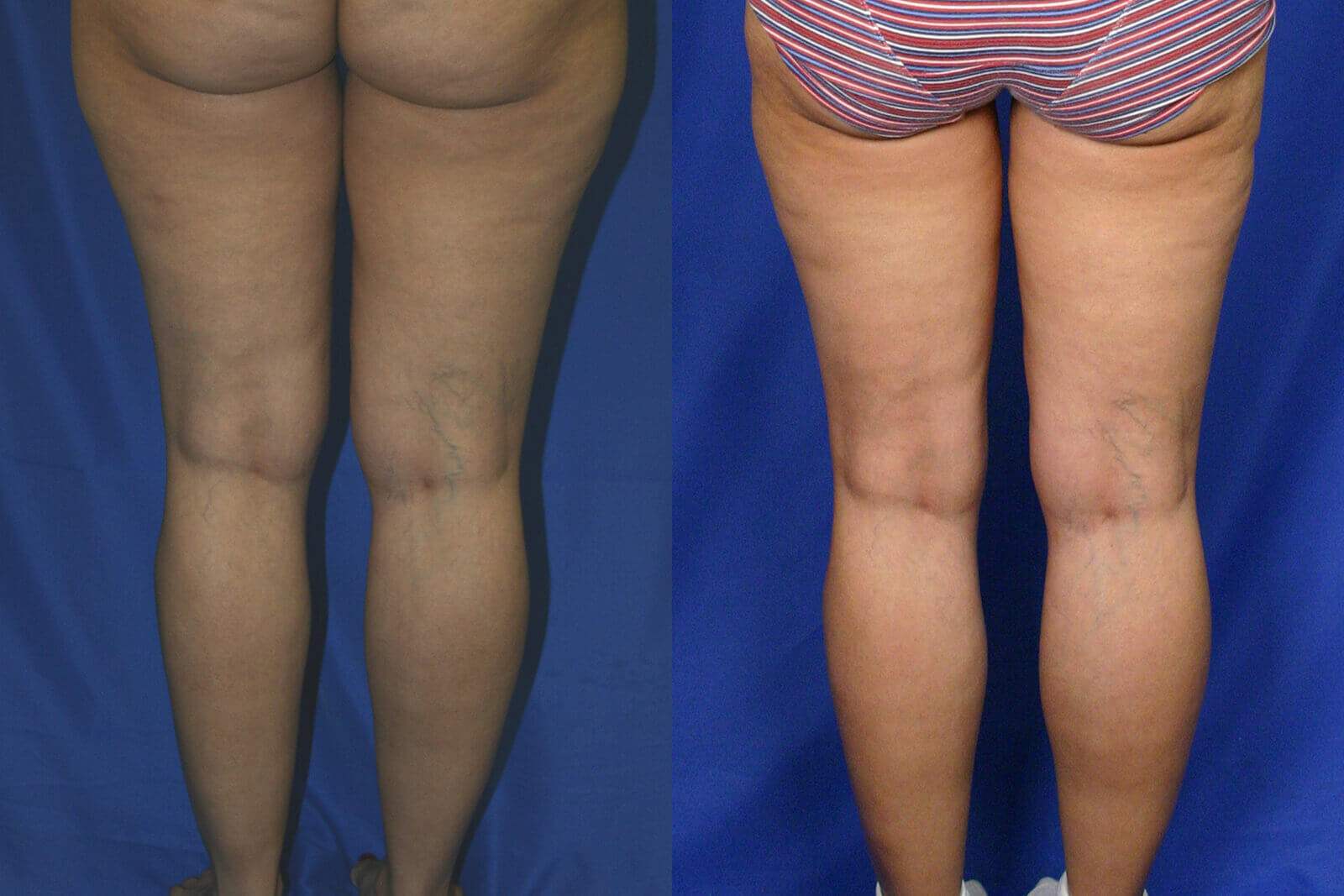 Case--8015 | Before and After Liposuction
