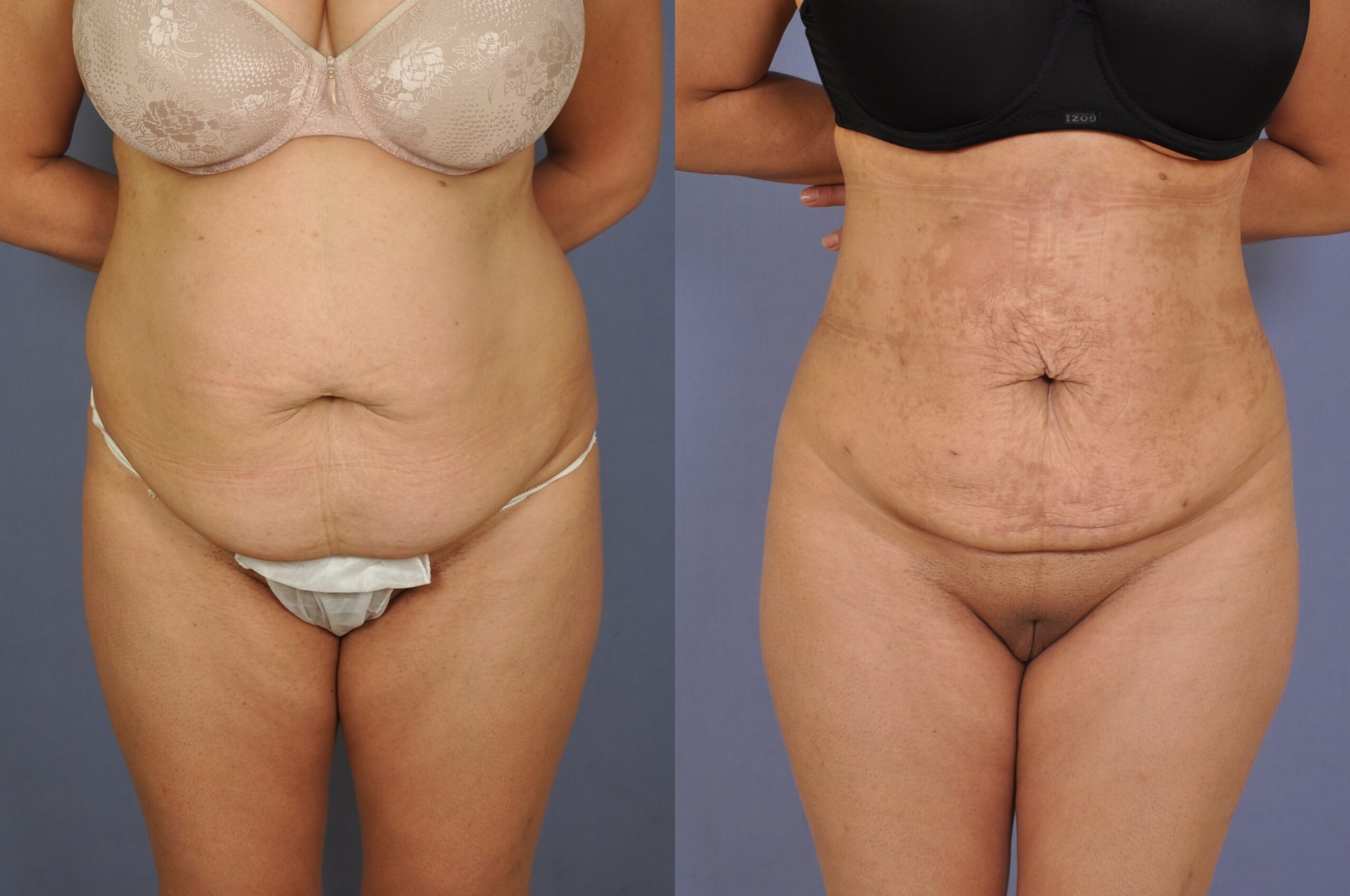 Case--8017 | Before and After Liposuction