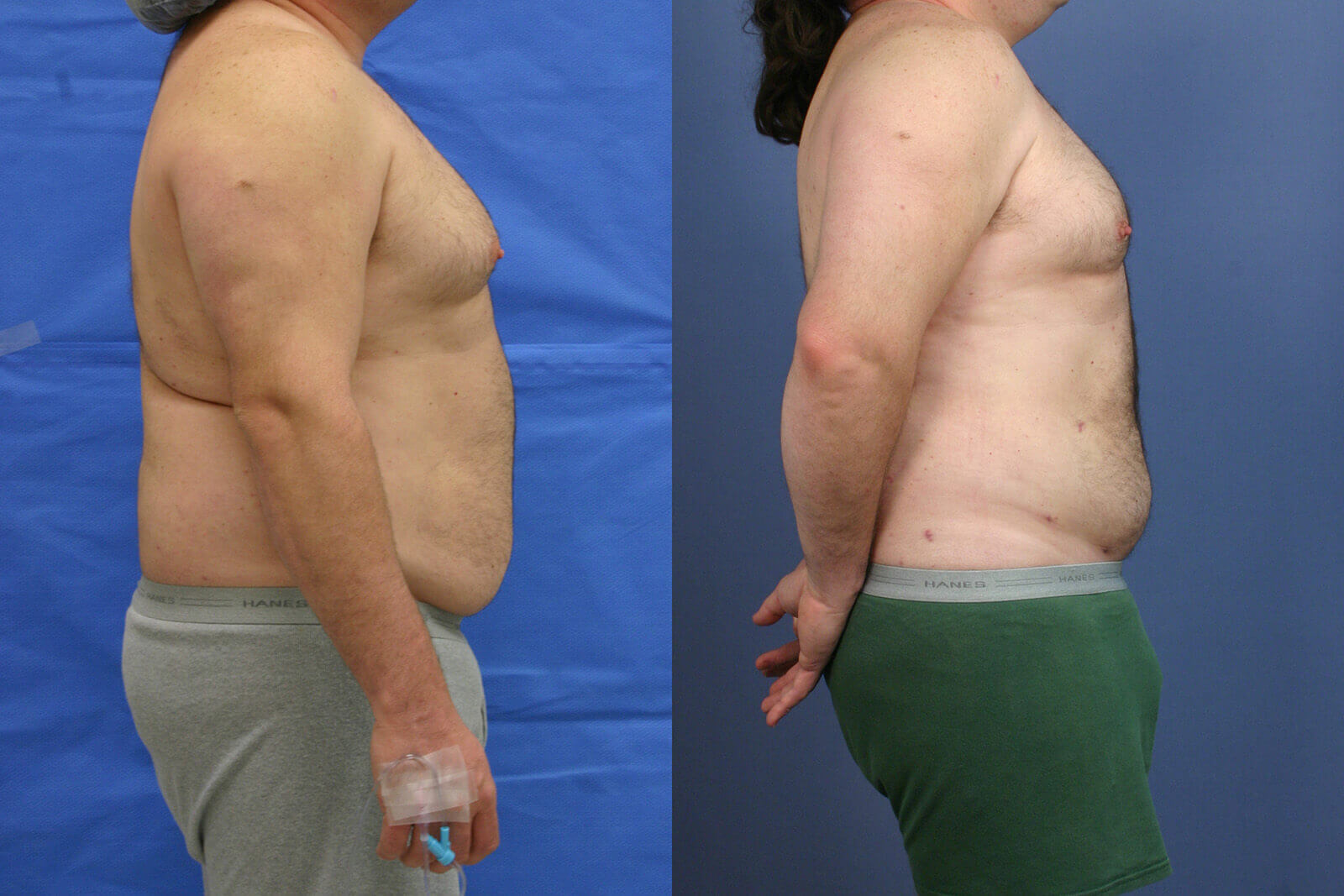Case--8003 | Before and After Liposuction