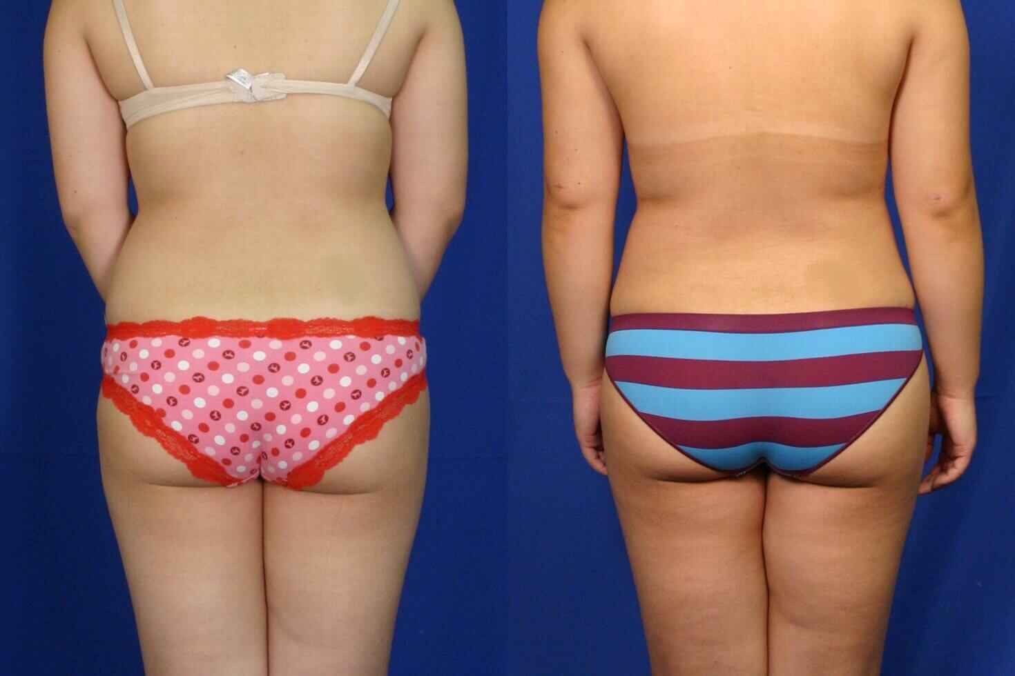 Case--8014 | Before and After Liposuction