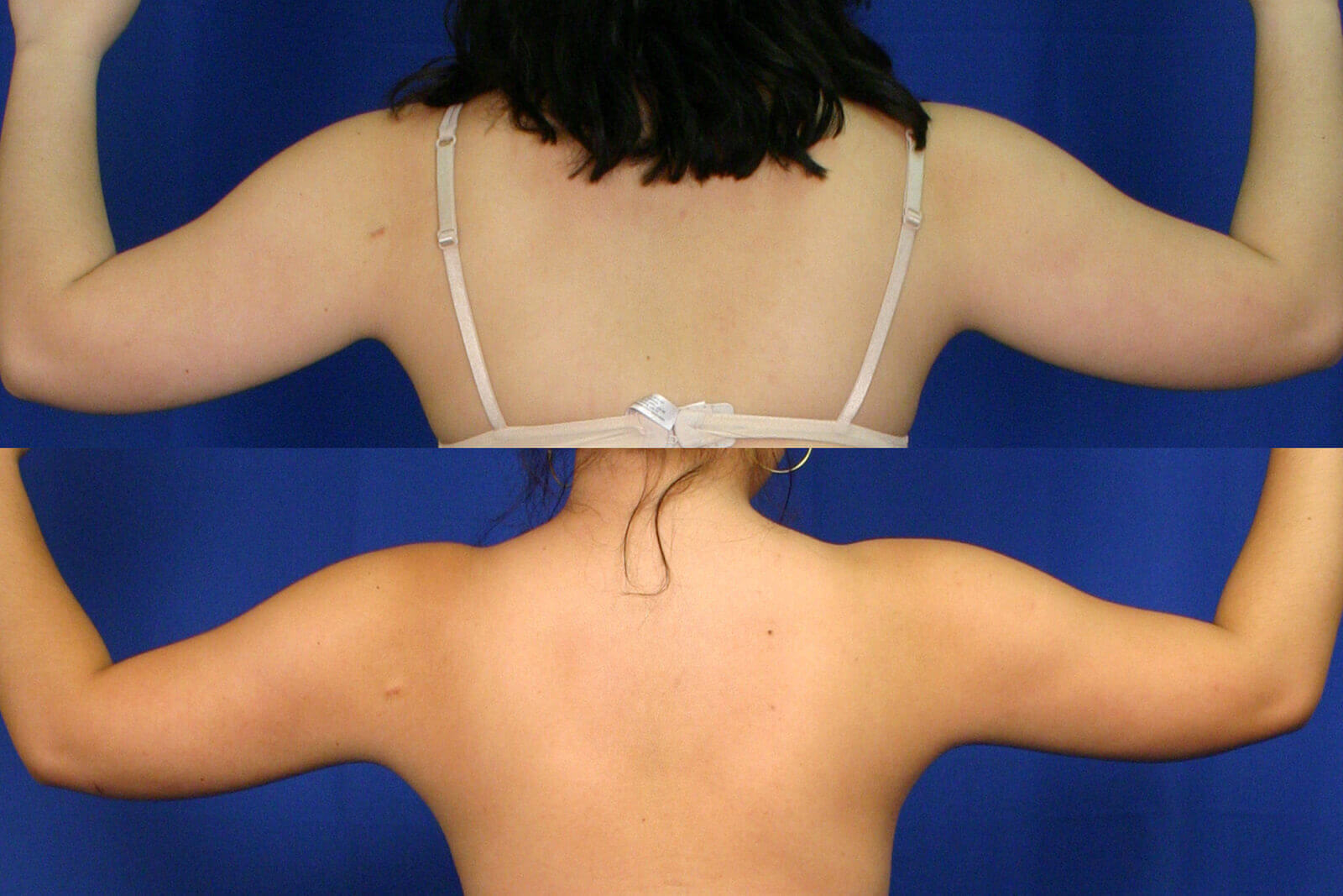 Case--8005 | Before and After Liposuction