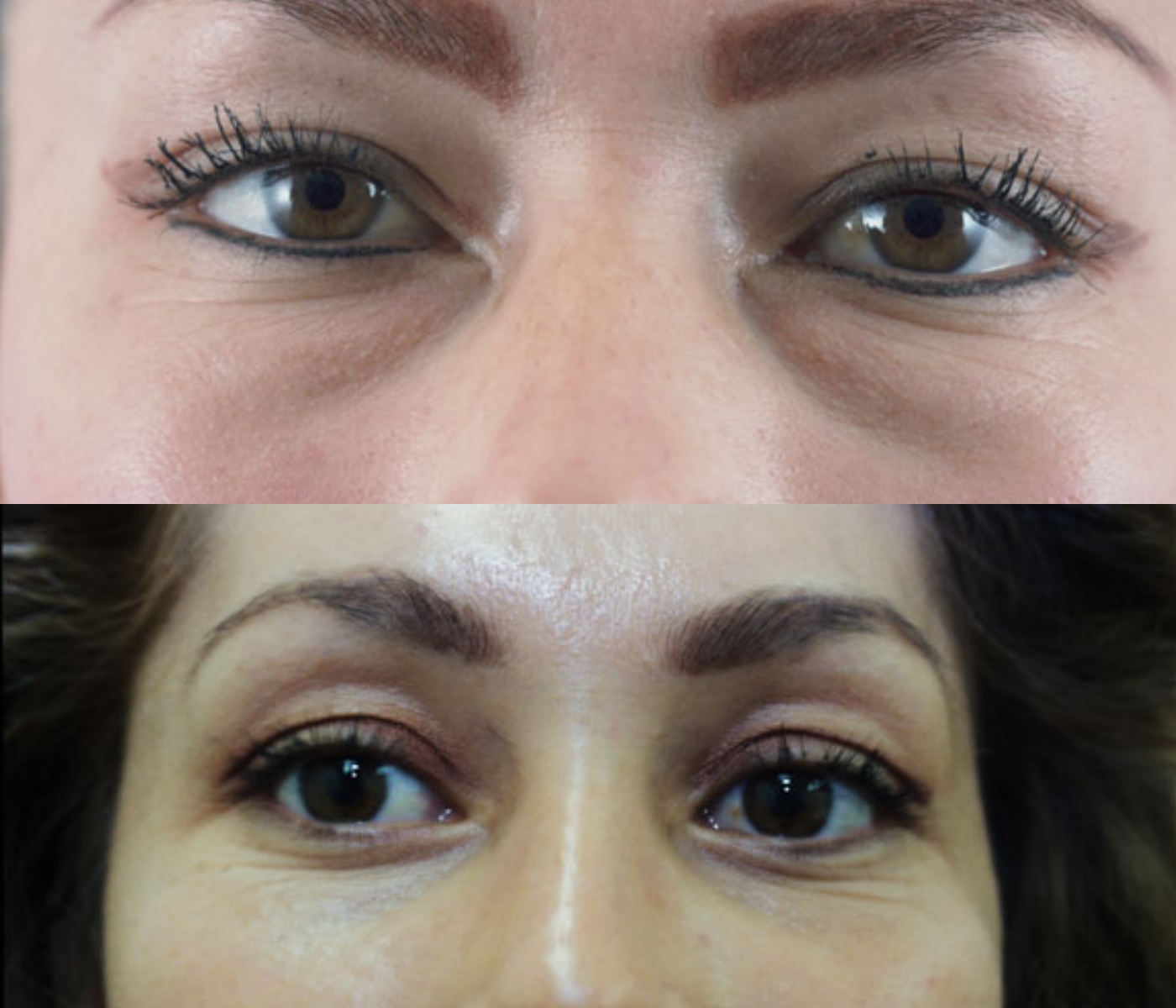 Case--0010 | Before and After Blepharoplasty