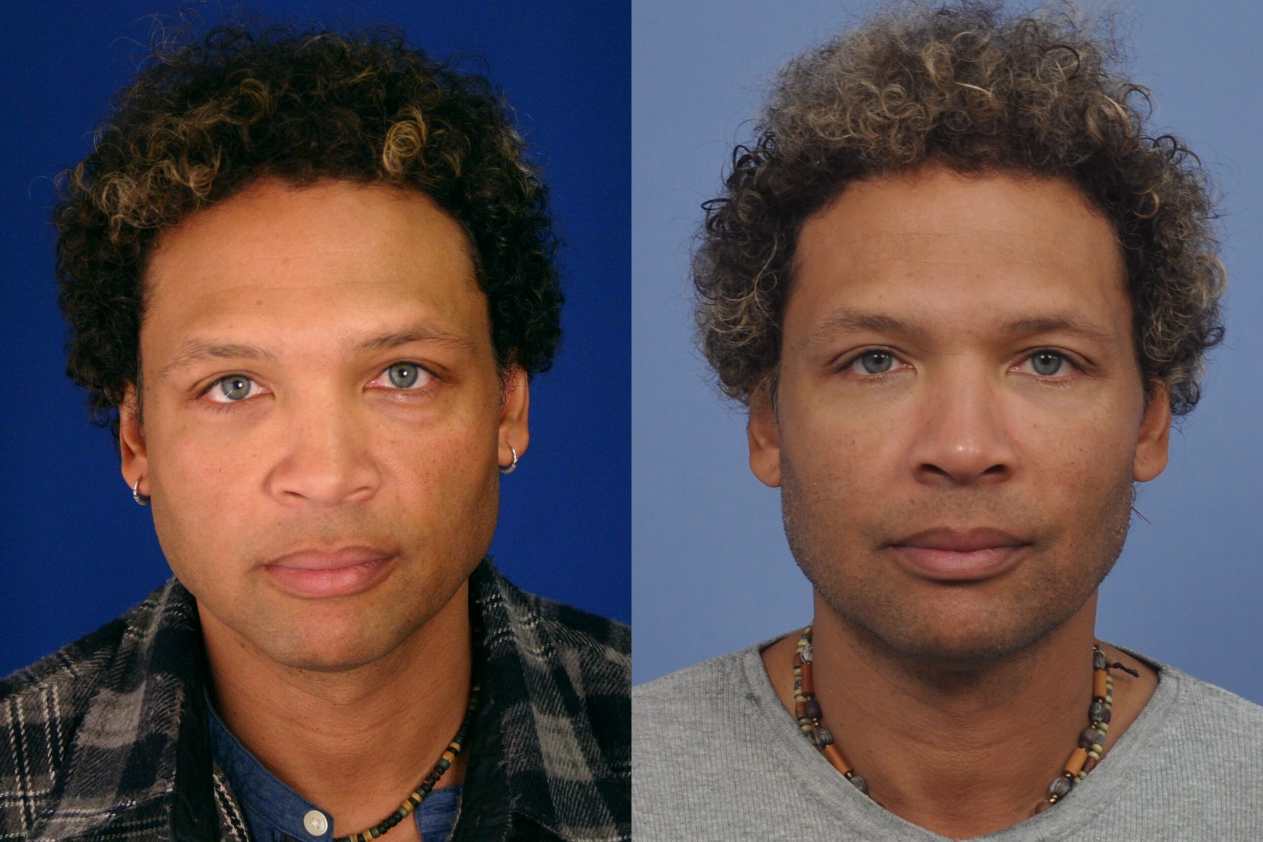 Case--0011 | Before and After Blepharoplasty