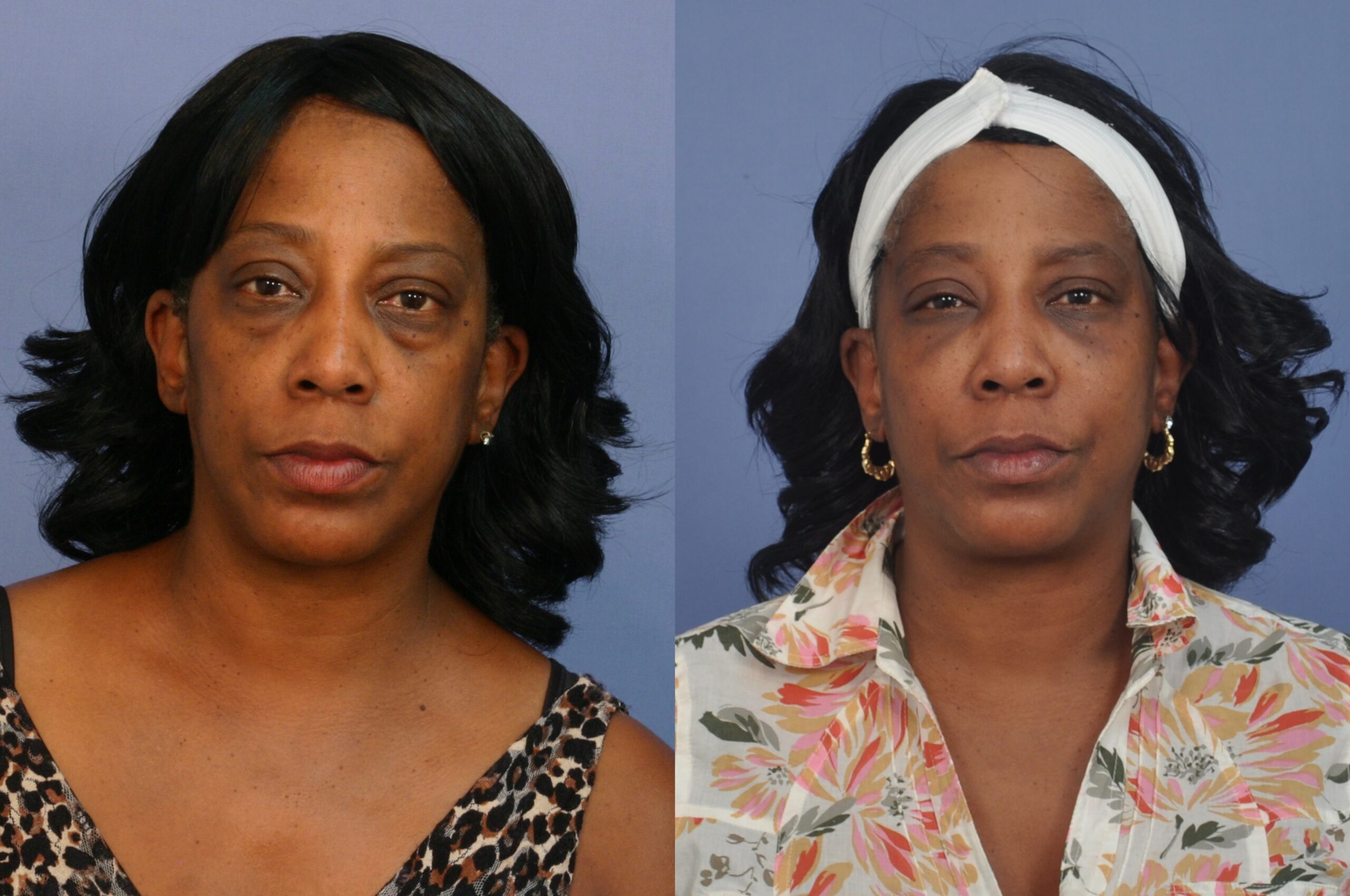 Case--0013 | Before and After Blepharoplasty