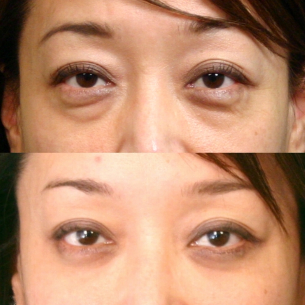 Case--0009 | Before and After Blepharoplasty
