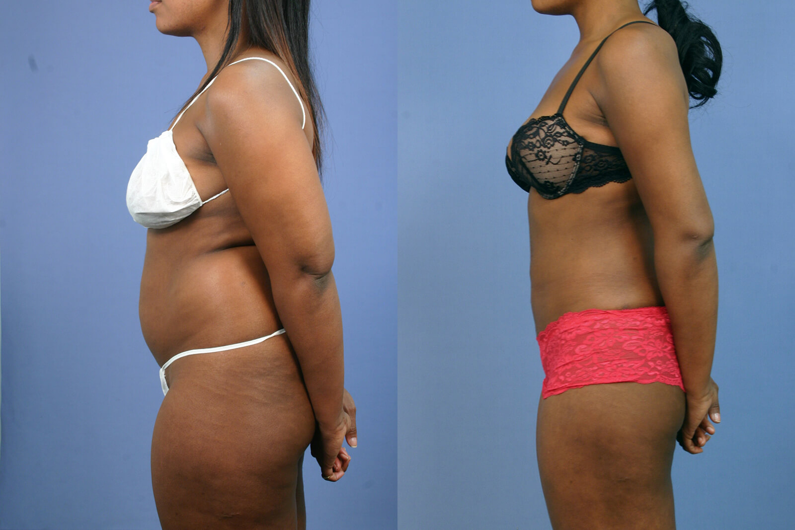 Case--8012 | Before and After Liposuction