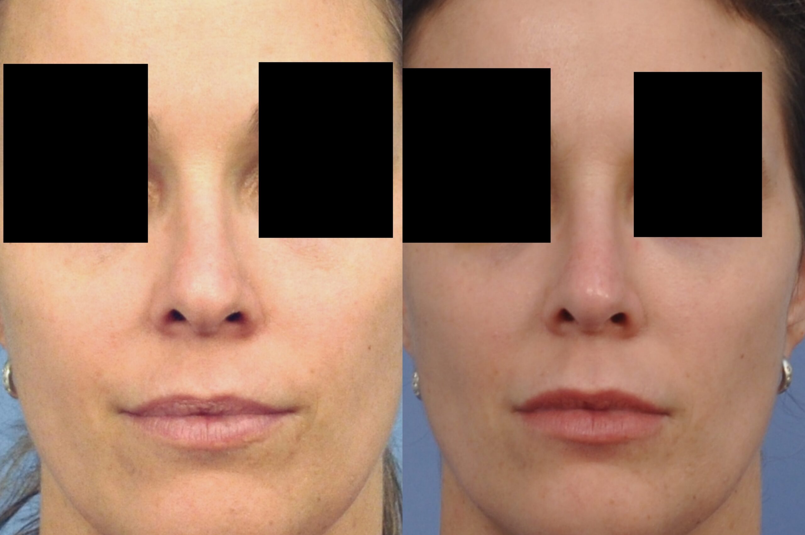 Case--4484 | Before and After Non Surgical Rhinoplasty