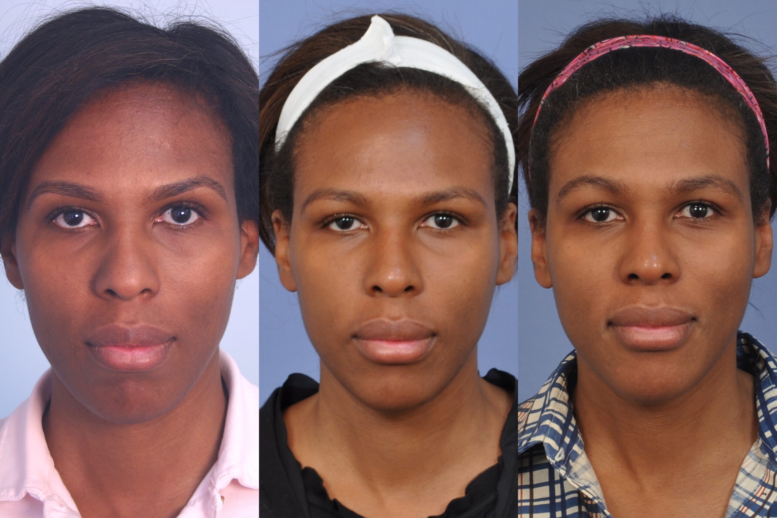 Case--4489 | Before and After Non Surgical Rhinoplasty