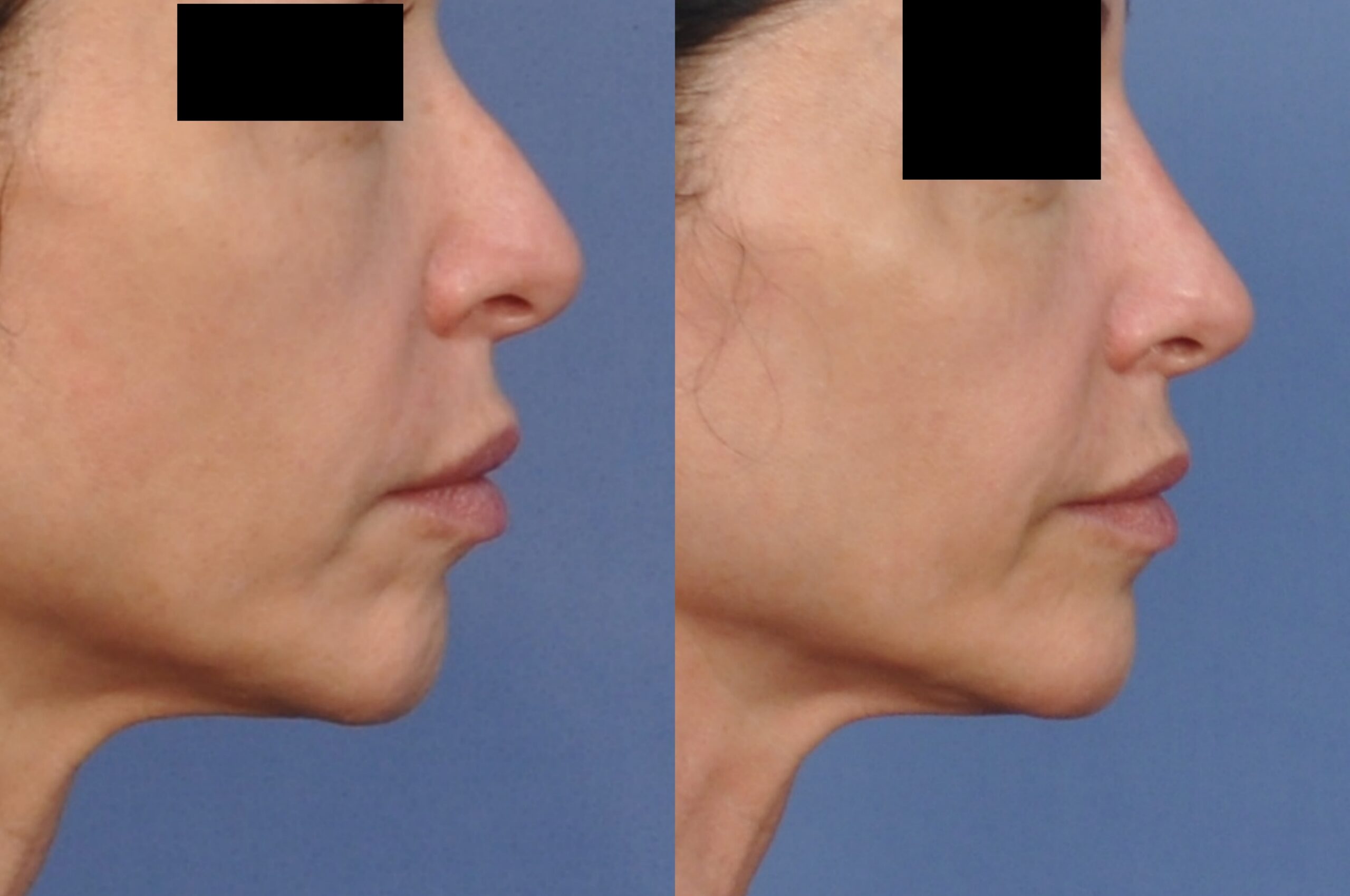 Case--4486 | Before and After Non Surgical Rhinoplasty