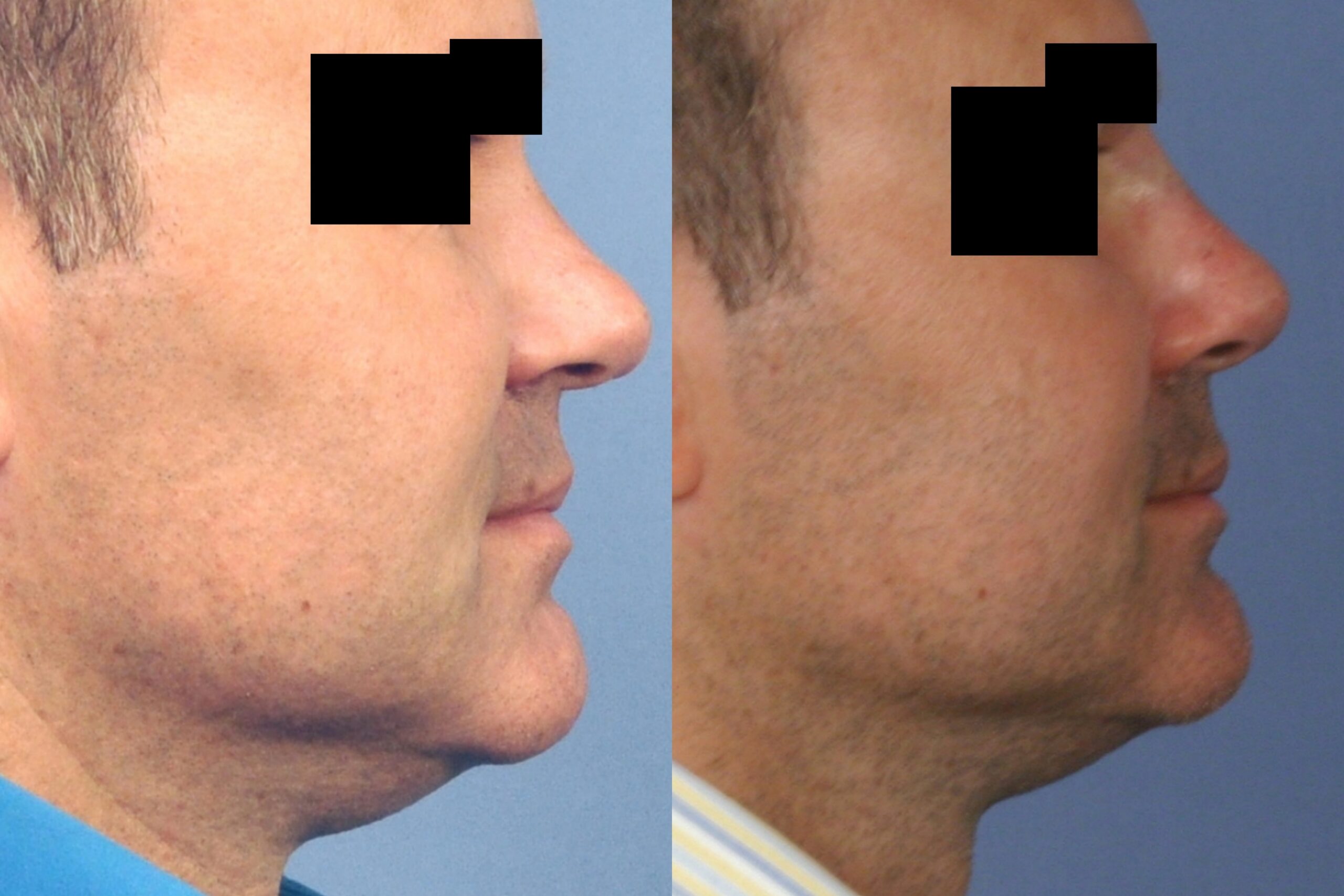 Case--4488 | Before and After Non Surgical Rhinoplasty