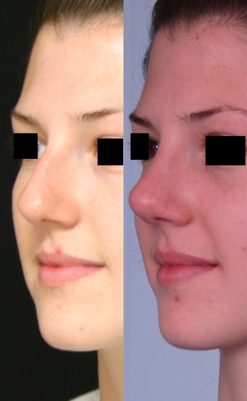 Case--1019 | Before and After Rhinoplasty