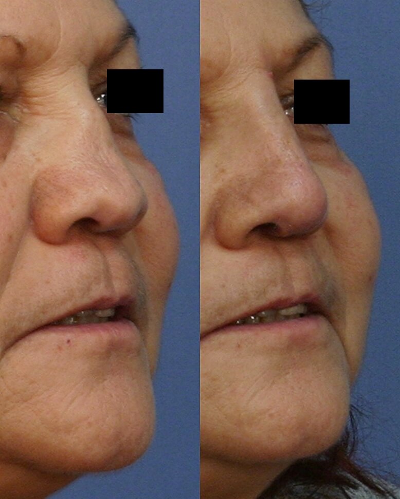 Case--1015 | Before and After Rhinoplasty
