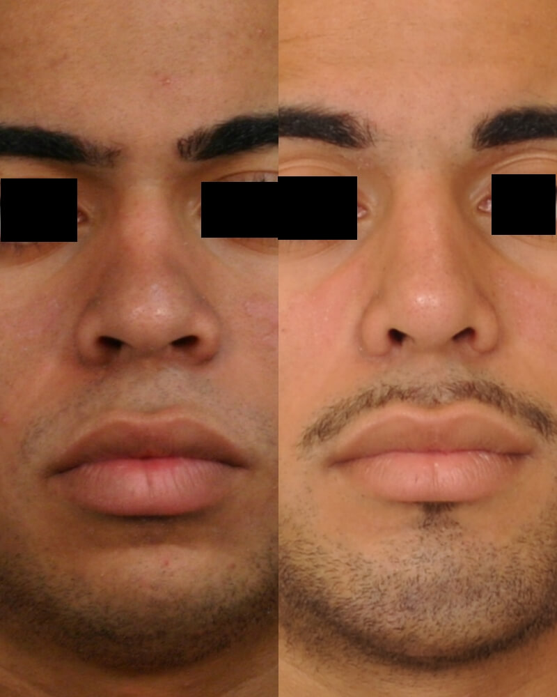 Case--1014 | Before and After Rhinoplasty