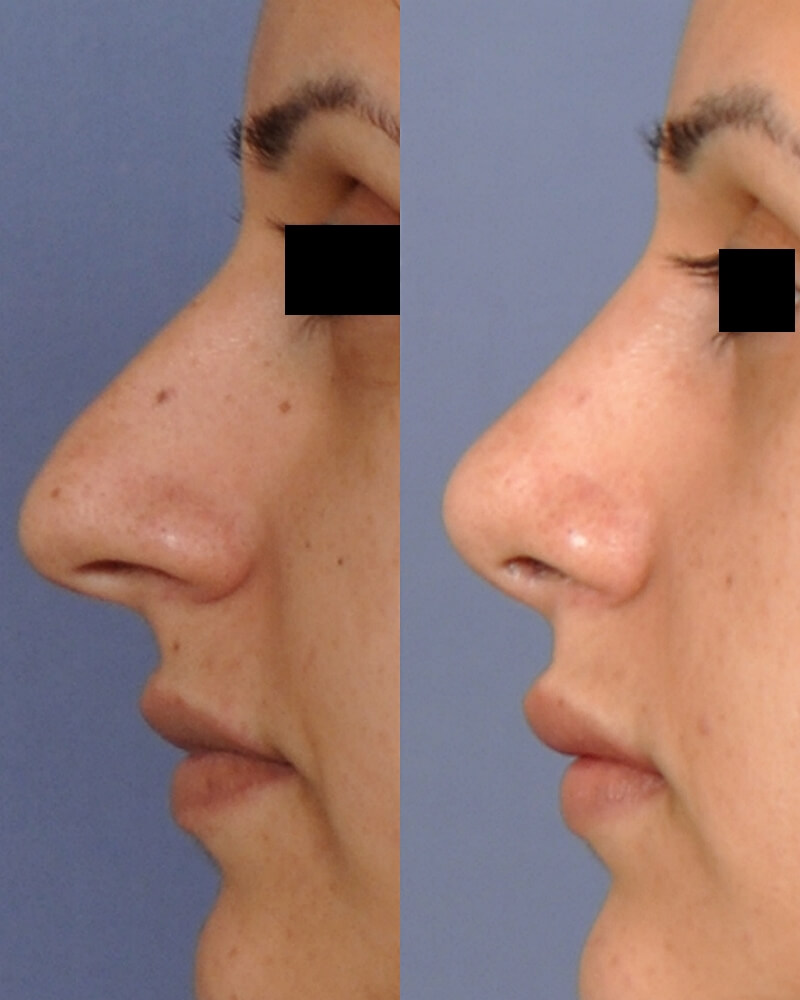 Case--1011 | Before and After Rhinoplasty