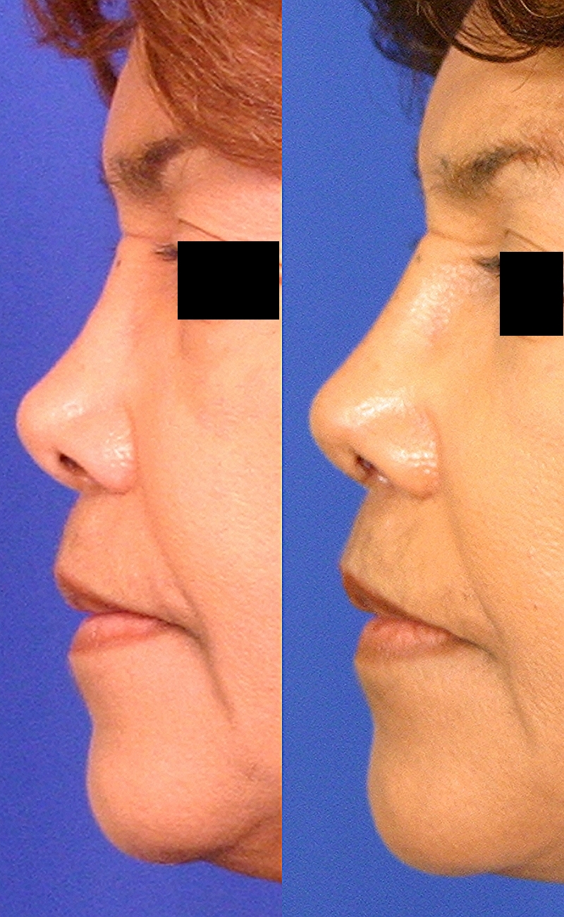 Case--1016 | Before and After Rhinoplasty