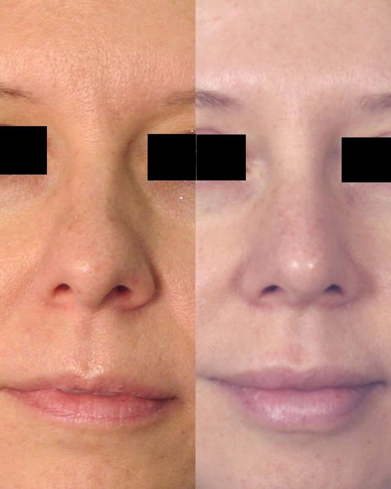 Case--1018 | Before and After Rhinoplasty