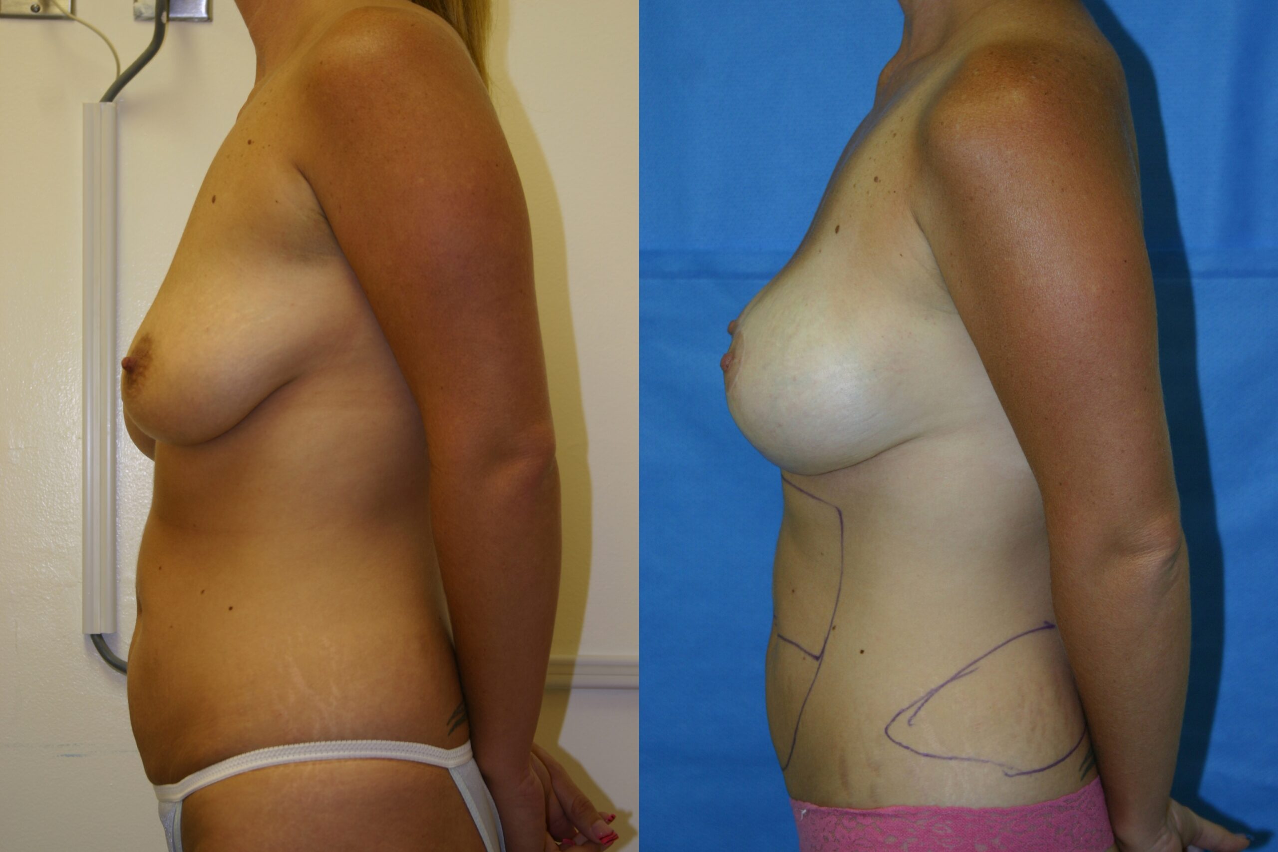 Breast-lift-patient-01 | Before and After Breast Lift
